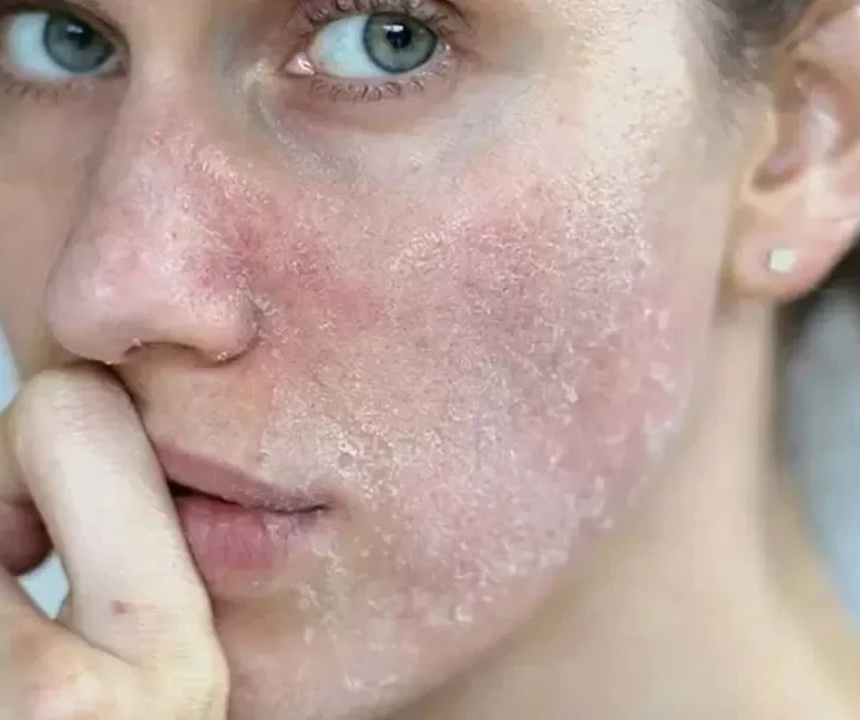 Sonbaharda Cilt Alarmı: Aynı Anda Hem Kuruyor Hem Yağlanıyor!