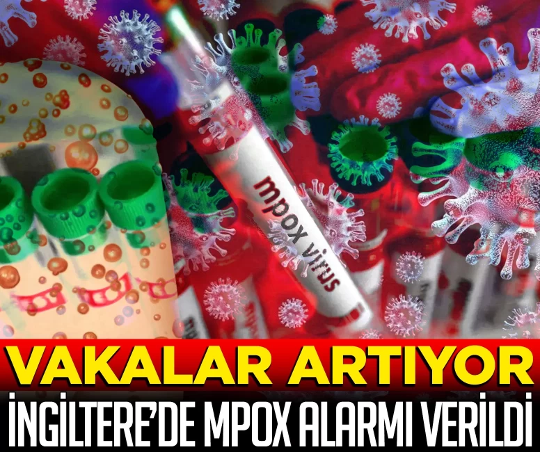İngiltere’de Mpox alarmı verildi