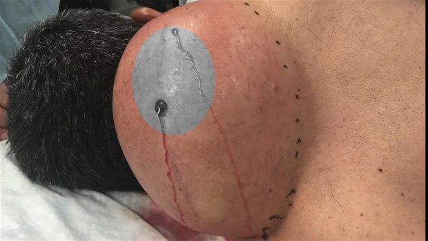 Boynundan çıkan şey mide bulandırdı! İnanılmaz... 3