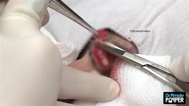 Göz kenarında kist vardı! İçi bakın nasılmış 19