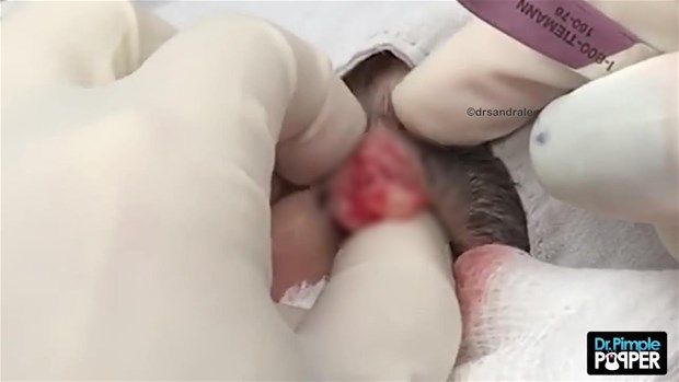 Göz kenarında kist vardı! İçi bakın nasılmış 44