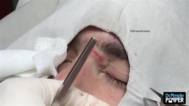 Göz kenarında kist vardı! İçi bakın nasılmış 35