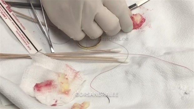 Göz kenarında kist vardı! İçi bakın nasılmış 8