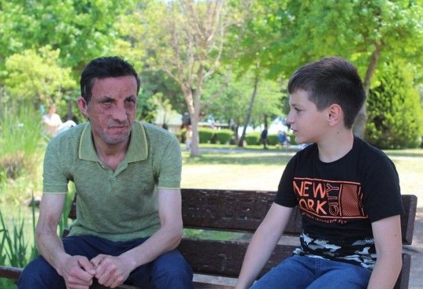 7,5 yıl önce yüz nakli olmuştu! İşte son hali 4