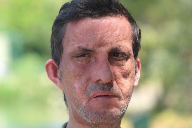 7,5 yıl önce yüz nakli olmuştu! İşte son hali 2