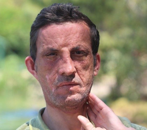 7,5 yıl önce yüz nakli olmuştu! İşte son hali 7