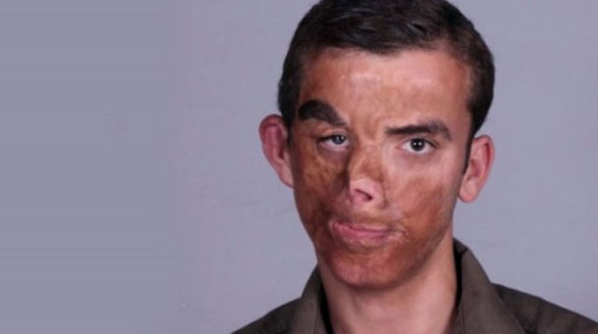 7,5 yıl önce yüz nakli olmuştu! İşte son hali 8