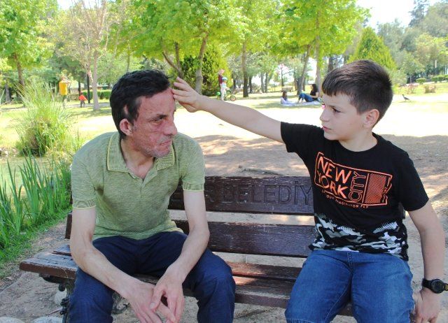 7,5 yıl önce yüz nakli olmuştu! İşte son hali 10