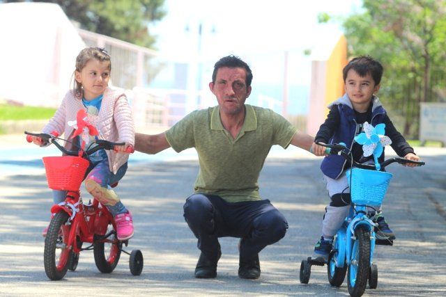 7,5 yıl önce yüz nakli olmuştu! İşte son hali 12