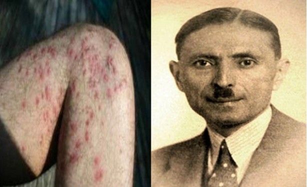 'Kanser' ismi nereden geliyor? 7