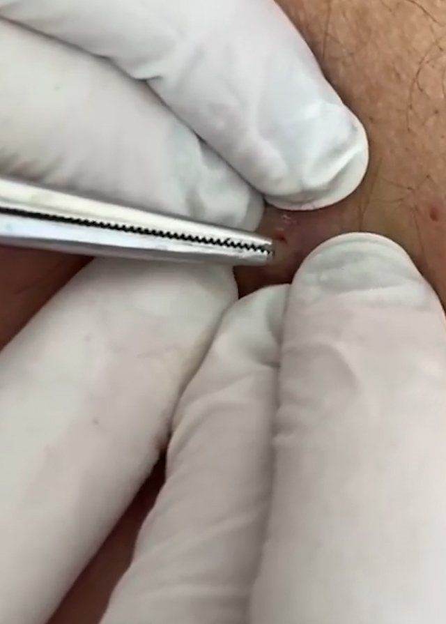 Sivilce şikayetiyle gitti, gerçeği öğrenince şok oldu! 3