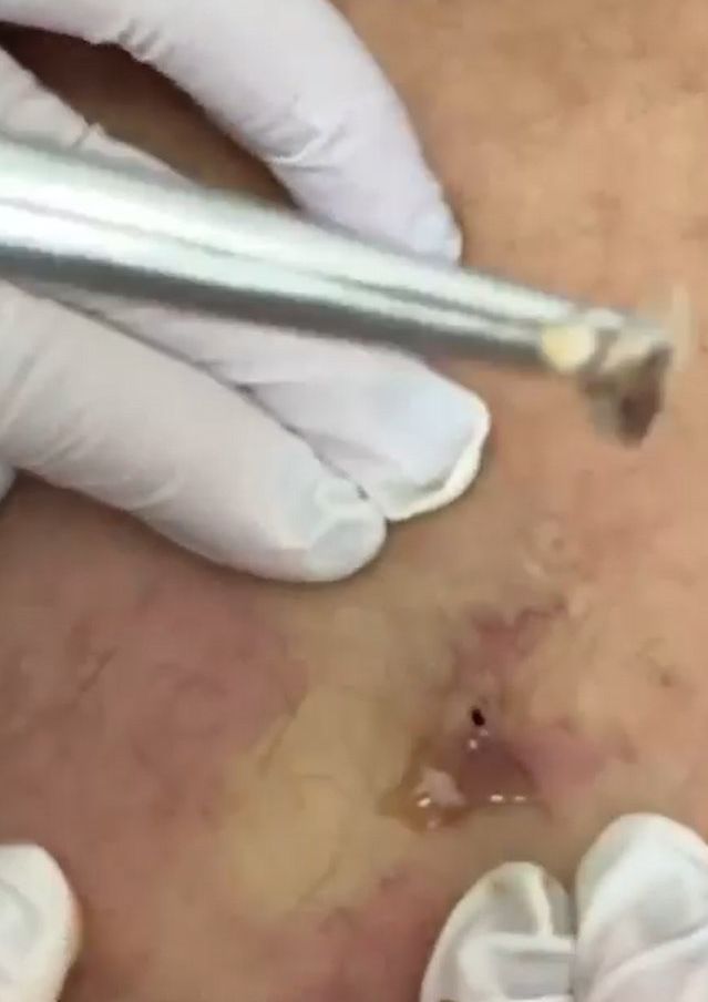 Sivilce şikayetiyle gitti, gerçeği öğrenince şok oldu! 16