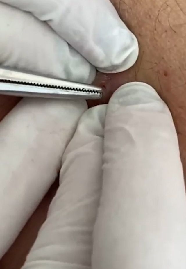 Sivilce şikayetiyle gitti, gerçeği öğrenince şok oldu! 4