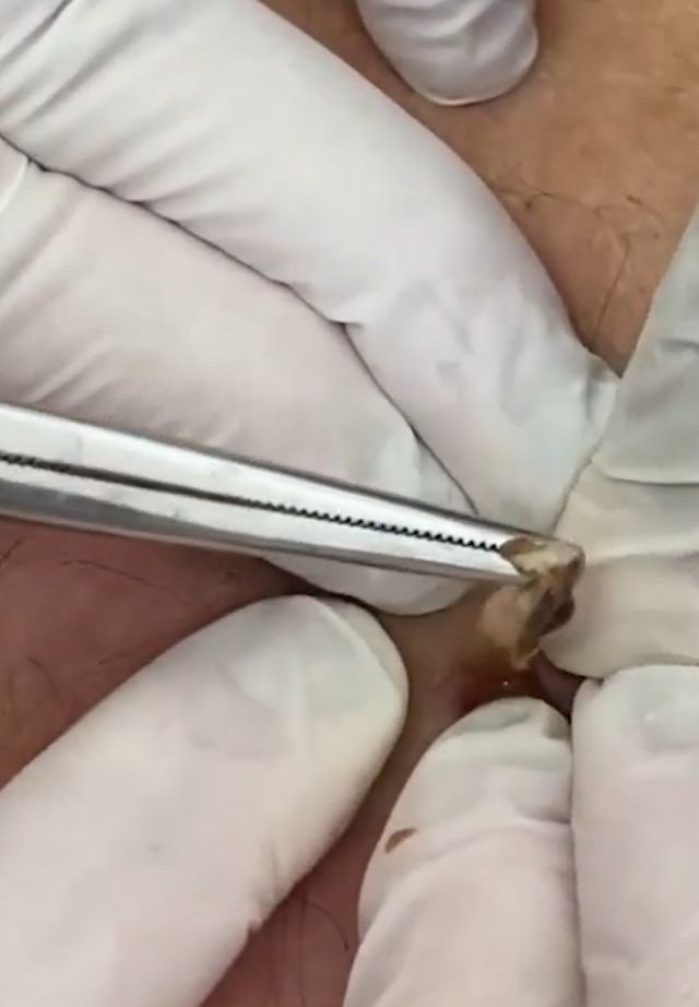 Sivilce şikayetiyle gitti, gerçeği öğrenince şok oldu! 13