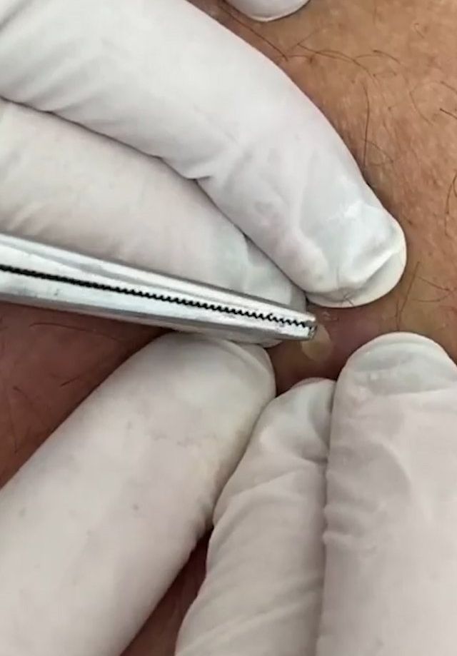 Sivilce şikayetiyle gitti, gerçeği öğrenince şok oldu! 5