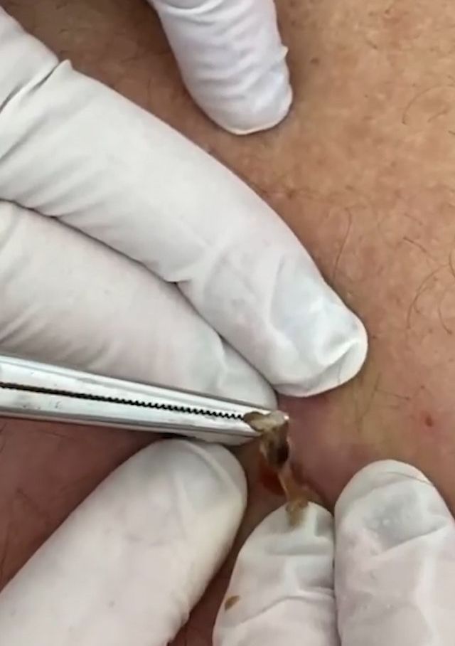 Sivilce şikayetiyle gitti, gerçeği öğrenince şok oldu! 8