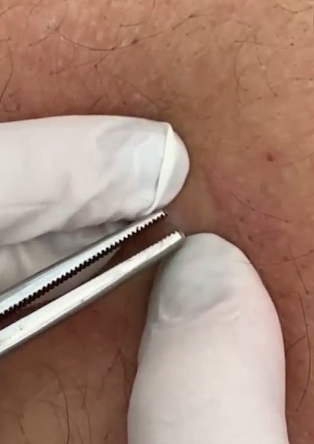 Sivilce şikayetiyle gitti, gerçeği öğrenince şok oldu! 2