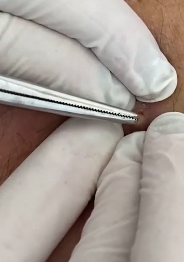 Sivilce şikayetiyle gitti, gerçeği öğrenince şok oldu! 6