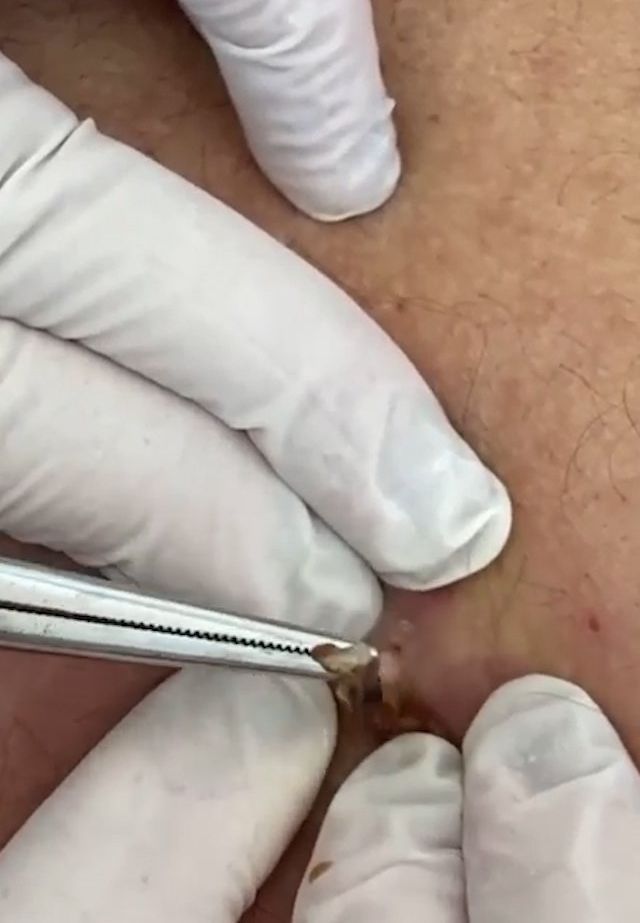 Sivilce şikayetiyle gitti, gerçeği öğrenince şok oldu! 9