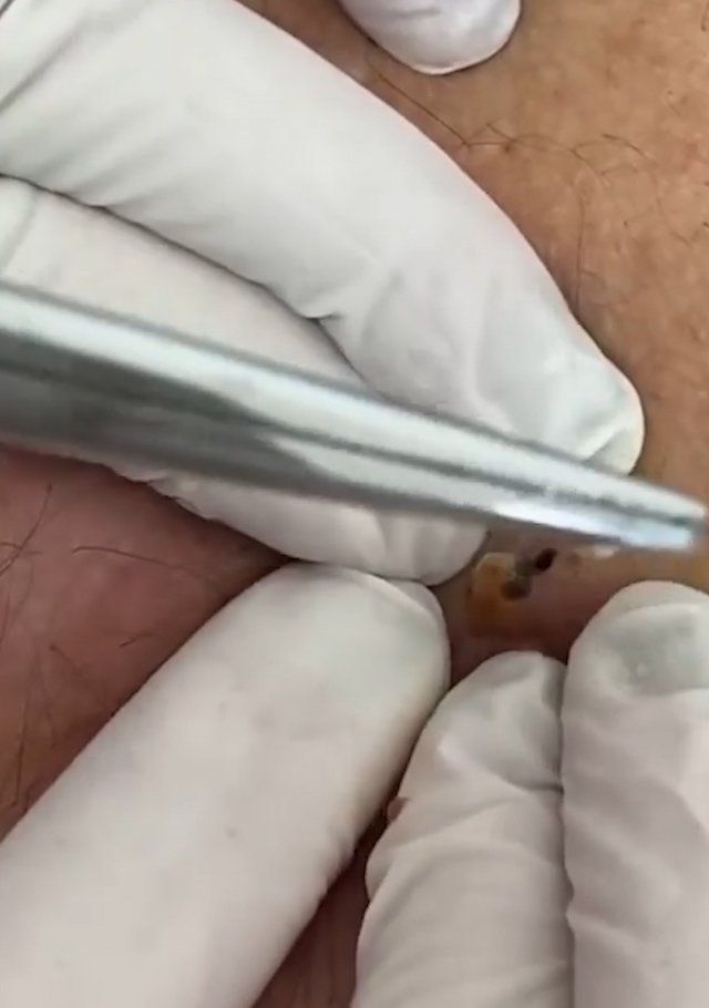 Sivilce şikayetiyle gitti, gerçeği öğrenince şok oldu! 15