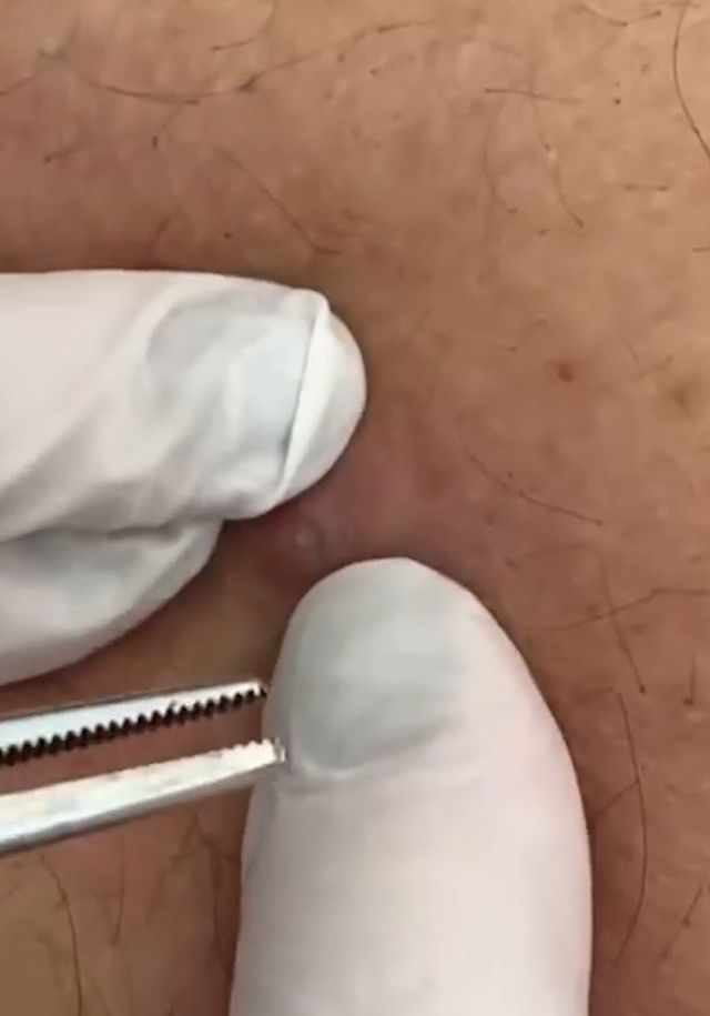 Sivilce şikayetiyle gitti, gerçeği öğrenince şok oldu! 1