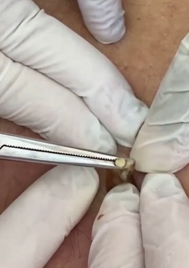 Sivilce şikayetiyle gitti, gerçeği öğrenince şok oldu! 17