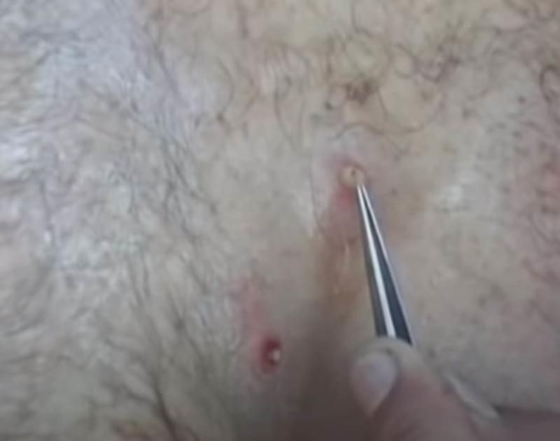 Sivilce zannetti ama gerçek dehşete düşürdü! 18