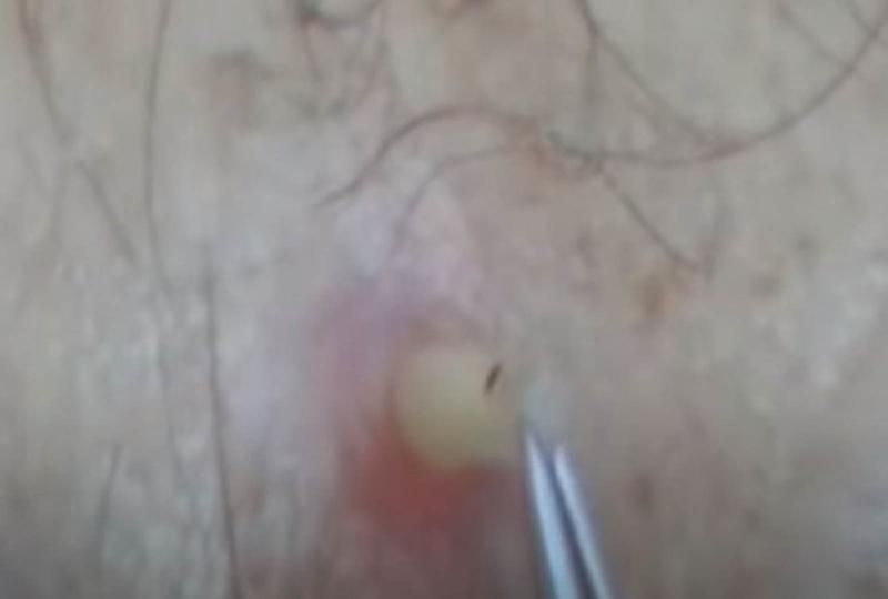 Sivilce zannetti ama gerçek dehşete düşürdü! 45