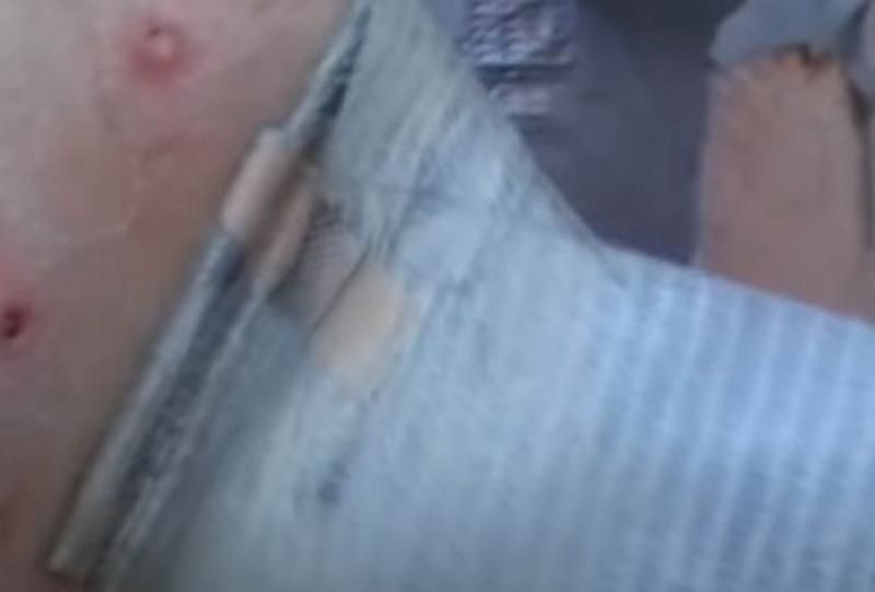 Sivilce zannetti ama gerçek dehşete düşürdü! 13