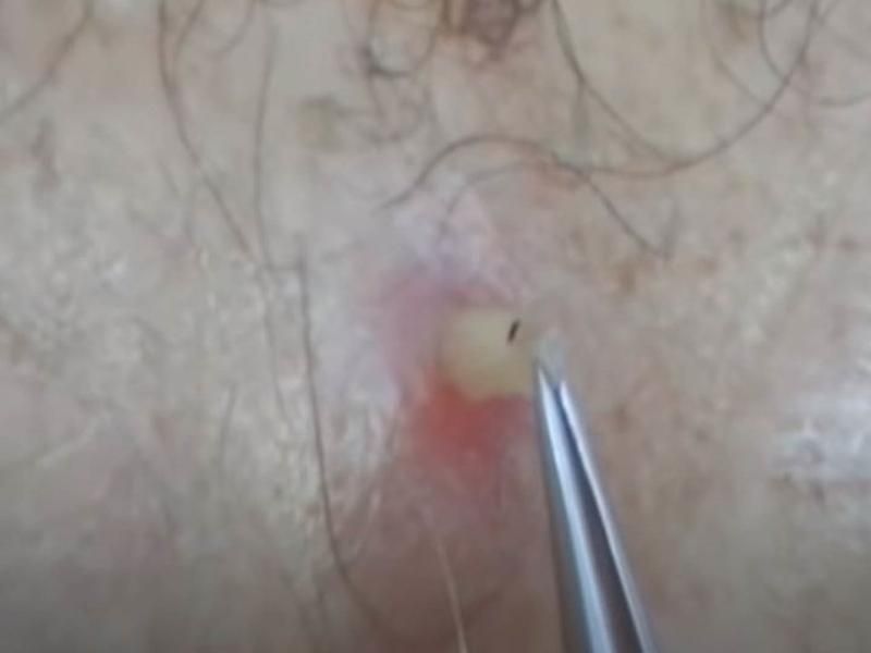 Sivilce zannetti ama gerçek dehşete düşürdü! 47