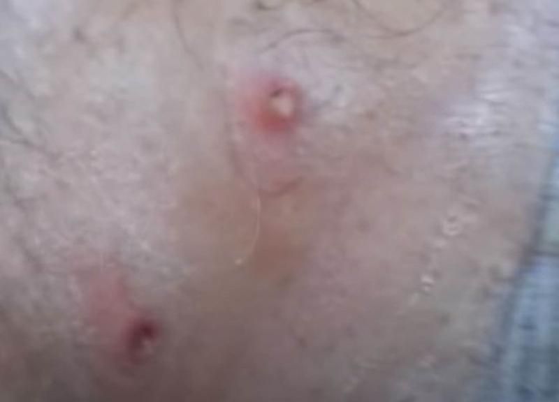 Sivilce zannetti ama gerçek dehşete düşürdü! 17