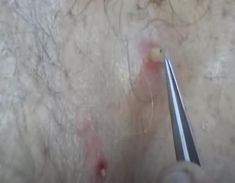 Sivilce zannetti ama gerçek dehşete düşürdü! 24