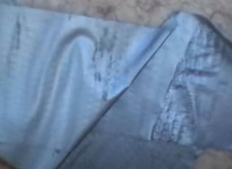 Sivilce zannetti ama gerçek dehşete düşürdü! 6