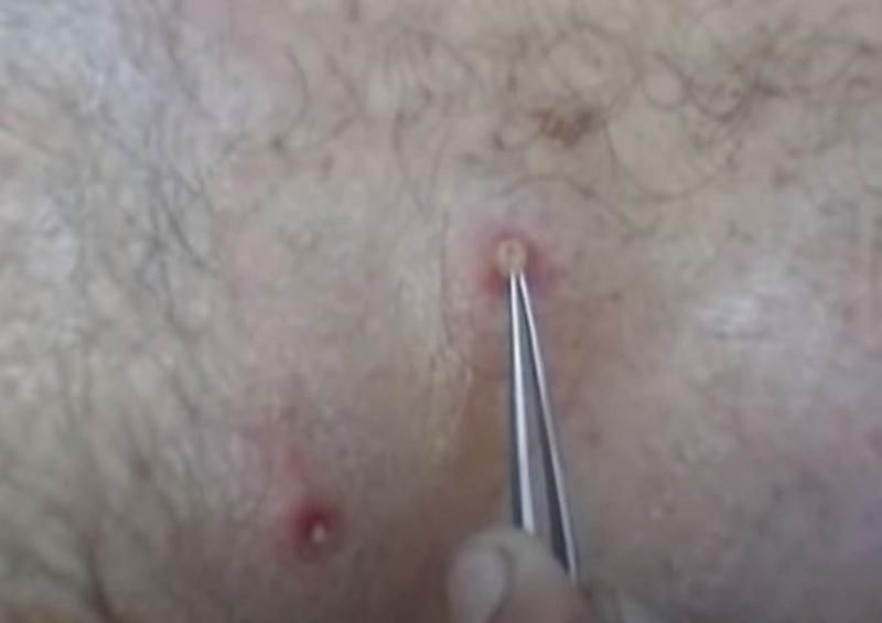 Sivilce zannetti ama gerçek dehşete düşürdü! 20