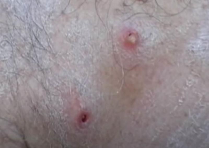 Sivilce zannetti ama gerçek dehşete düşürdü! 15