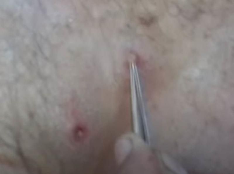 Sivilce zannetti ama gerçek dehşete düşürdü! 23