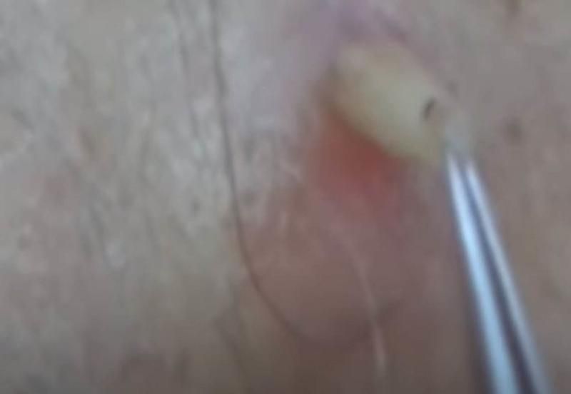 Sivilce zannetti ama gerçek dehşete düşürdü! 25