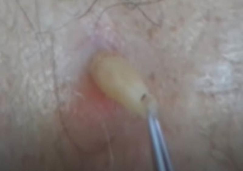 Sivilce zannetti ama gerçek dehşete düşürdü! 26