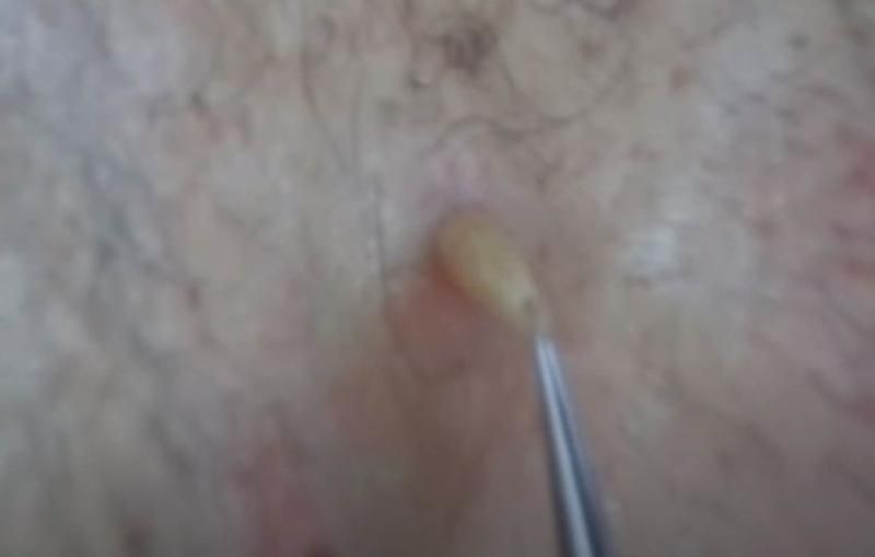 Sivilce zannetti ama gerçek dehşete düşürdü! 29