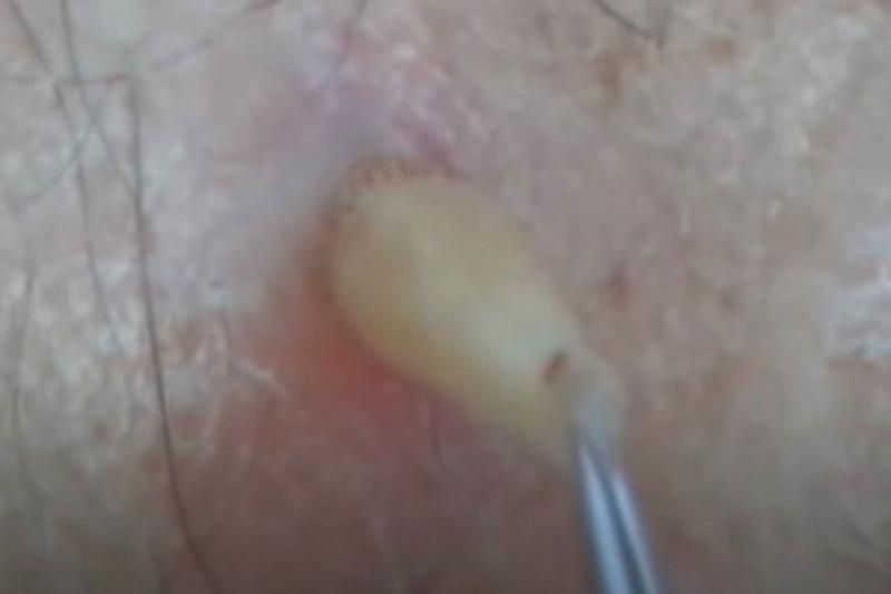 Sivilce zannetti ama gerçek dehşete düşürdü! 30