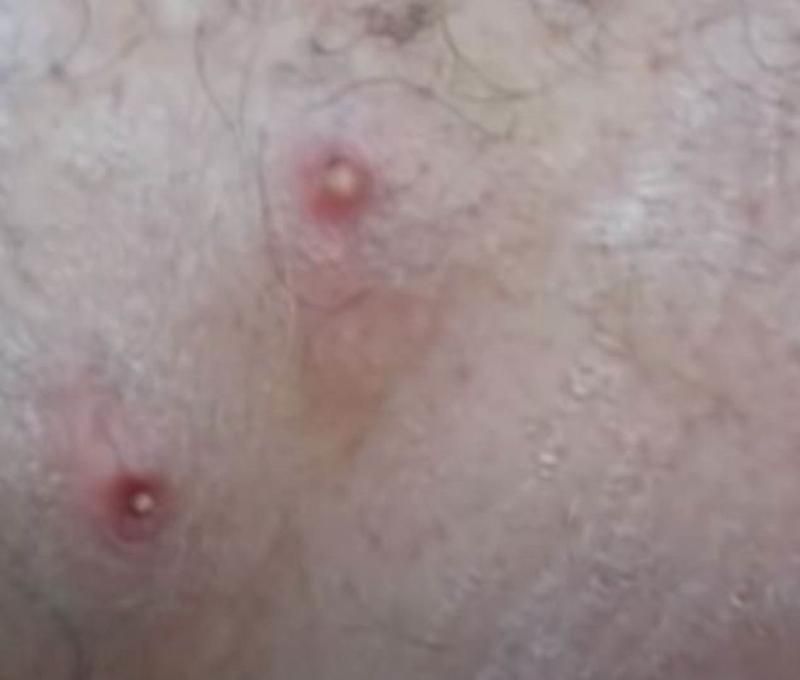 Sivilce zannetti ama gerçek dehşete düşürdü! 16