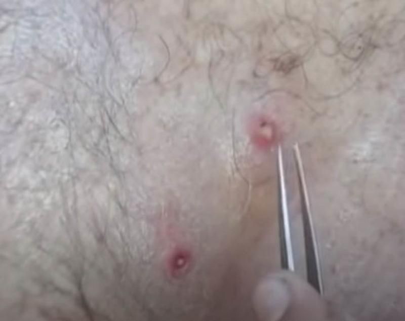 Sivilce zannetti ama gerçek dehşete düşürdü! 19