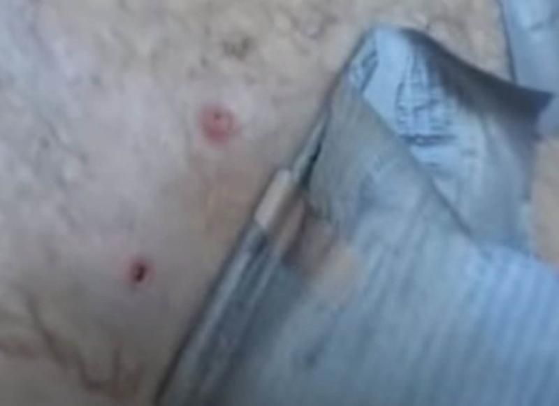 Sivilce zannetti ama gerçek dehşete düşürdü! 12