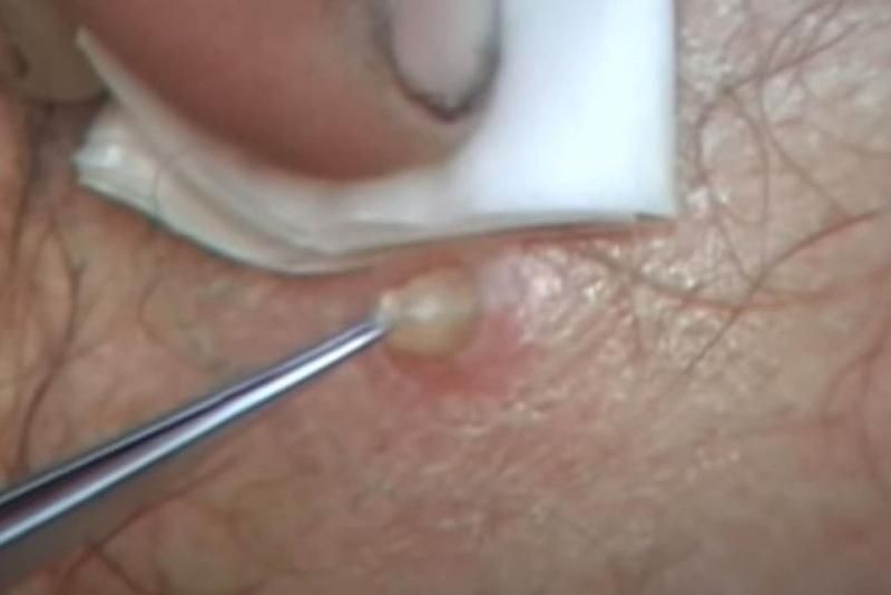 Sivilce zannetti ama gerçek dehşete düşürdü! 52