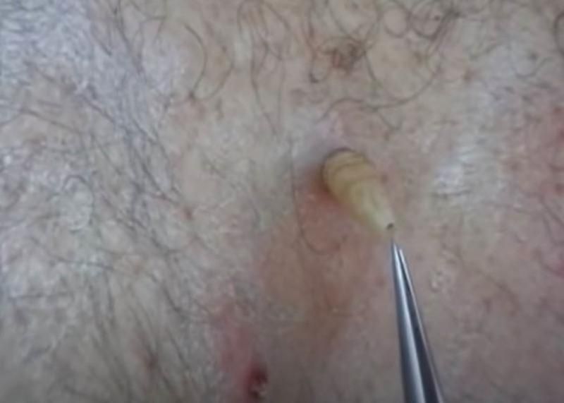 Sivilce zannetti ama gerçek dehşete düşürdü! 51