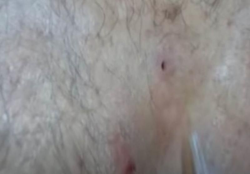 Sivilce zannetti ama gerçek dehşete düşürdü! 55