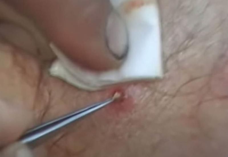 Sivilce zannetti ama gerçek dehşete düşürdü! 58