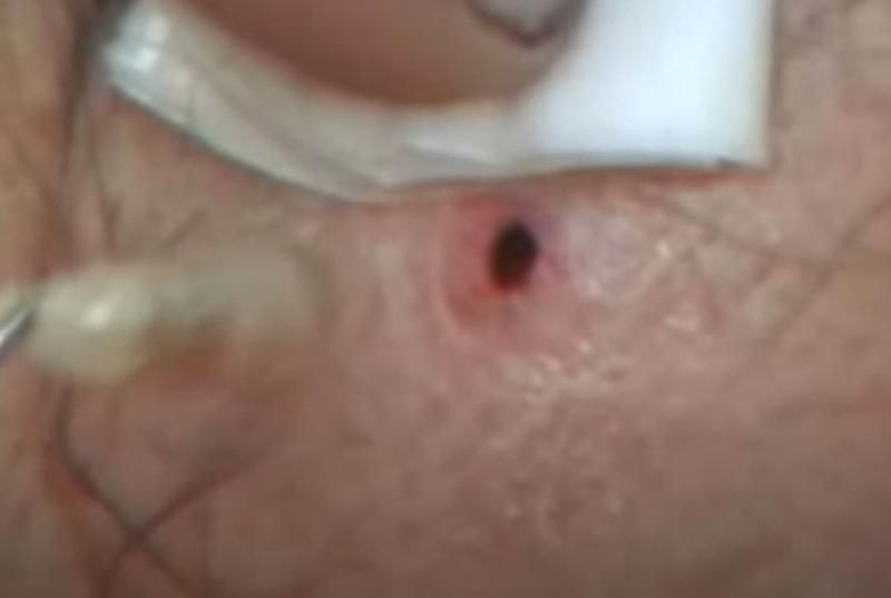 Sivilce zannetti ama gerçek dehşete düşürdü! 60