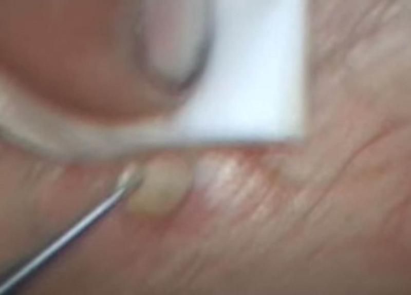 Sivilce zannetti ama gerçek dehşete düşürdü! 62