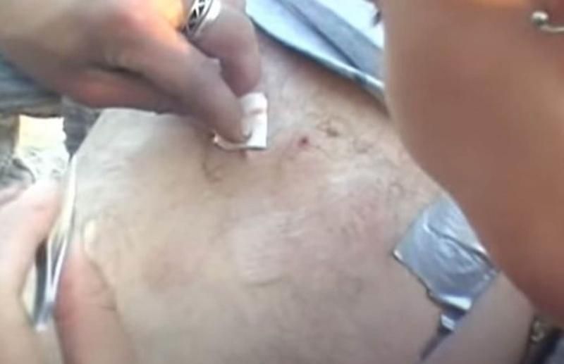 Sivilce zannetti ama gerçek dehşete düşürdü! 61